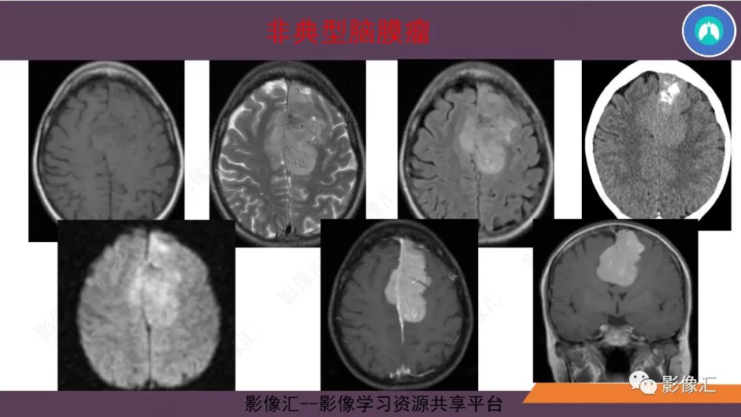 影像PPT - 【PPT】脑膜瘤15种亚型影像诊断-37