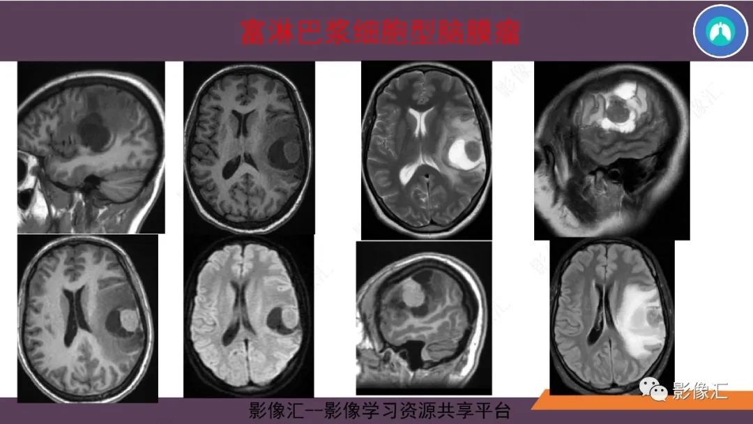 影像PPT - 【PPT】脑膜瘤15种亚型影像诊断-35