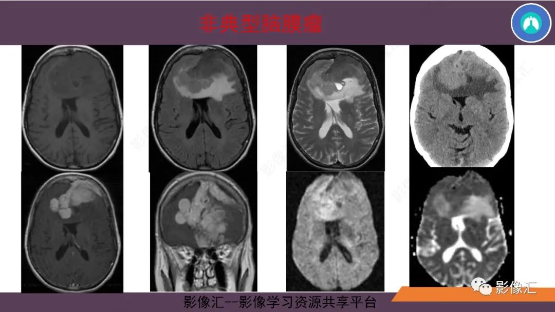 影像PPT - 【PPT】脑膜瘤15种亚型影像诊断-38