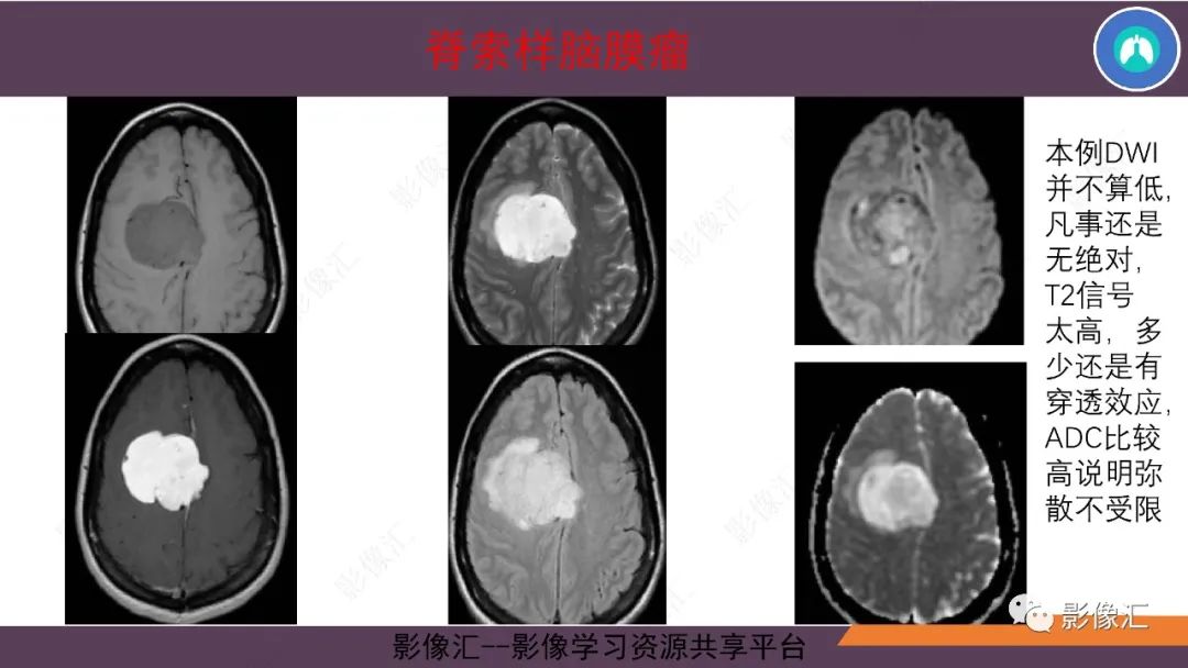 影像PPT - 【PPT】脑膜瘤15种亚型影像诊断-41