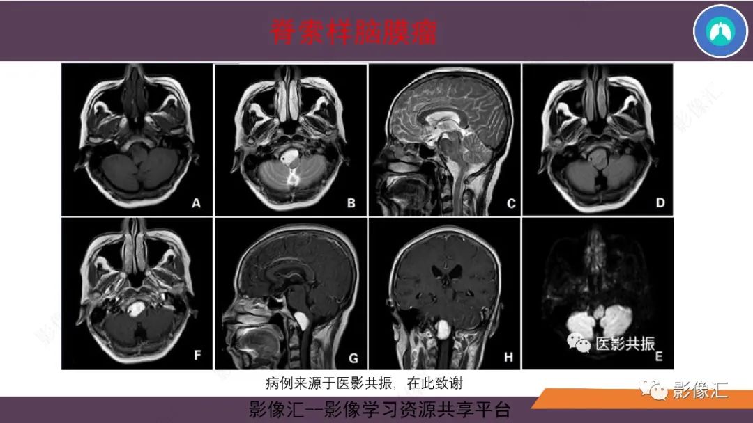 影像PPT - 【PPT】脑膜瘤15种亚型影像诊断-40