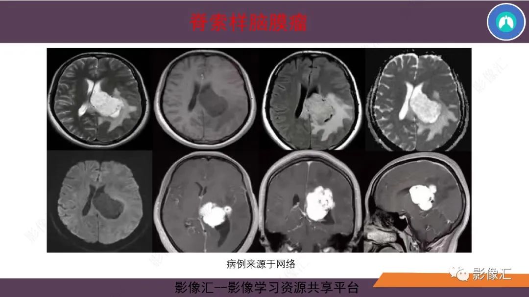 影像PPT - 【PPT】脑膜瘤15种亚型影像诊断-42