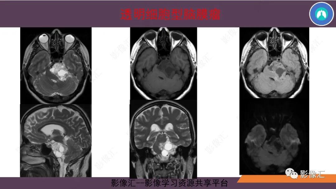 影像PPT - 【PPT】脑膜瘤15种亚型影像诊断-44