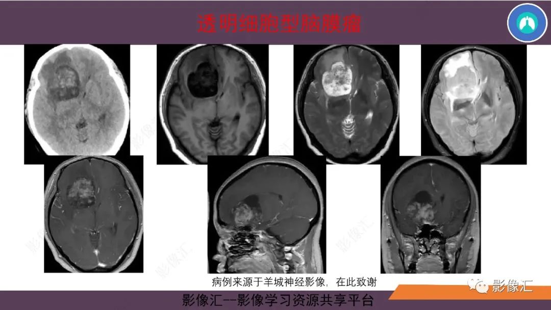影像PPT - 【PPT】脑膜瘤15种亚型影像诊断-45