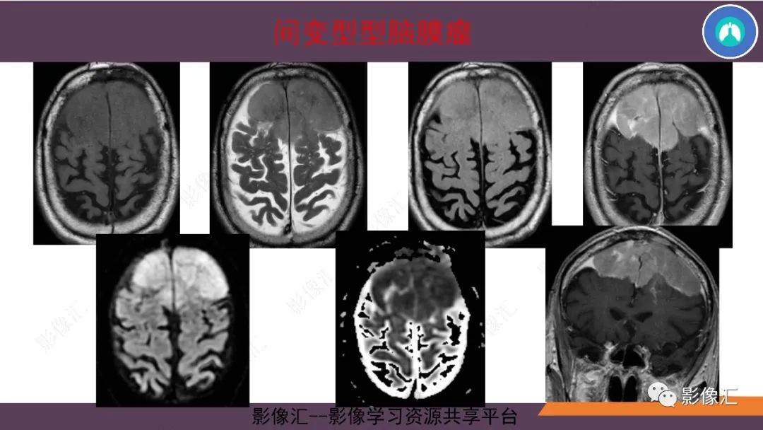 影像PPT - 【PPT】脑膜瘤15种亚型影像诊断-47