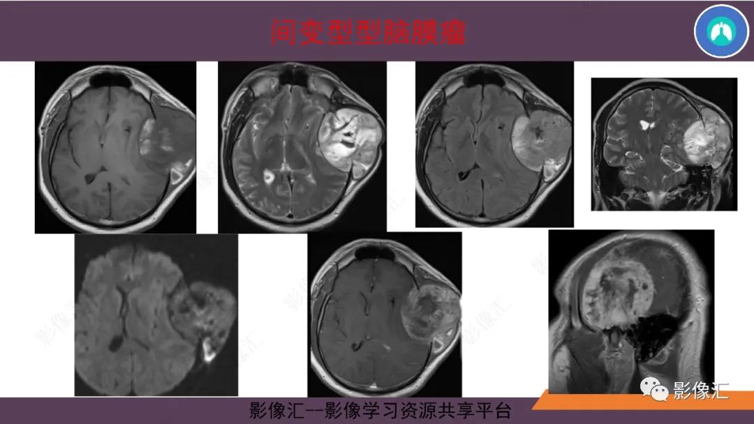 影像PPT - 【PPT】脑膜瘤15种亚型影像诊断-48