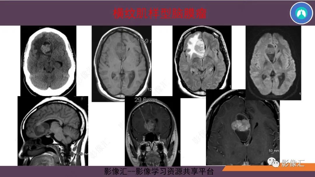 影像PPT - 【PPT】脑膜瘤15种亚型影像诊断-51