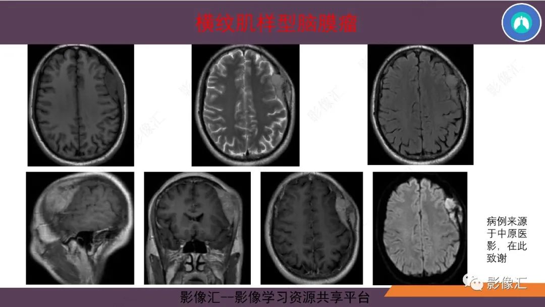 影像PPT - 【PPT】脑膜瘤15种亚型影像诊断-50