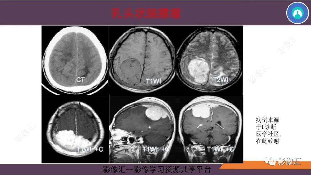 影像PPT - 【PPT】脑膜瘤15种亚型影像诊断-53