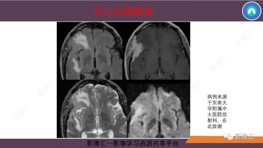 影像PPT - 【PPT】脑膜瘤15种亚型影像诊断-54