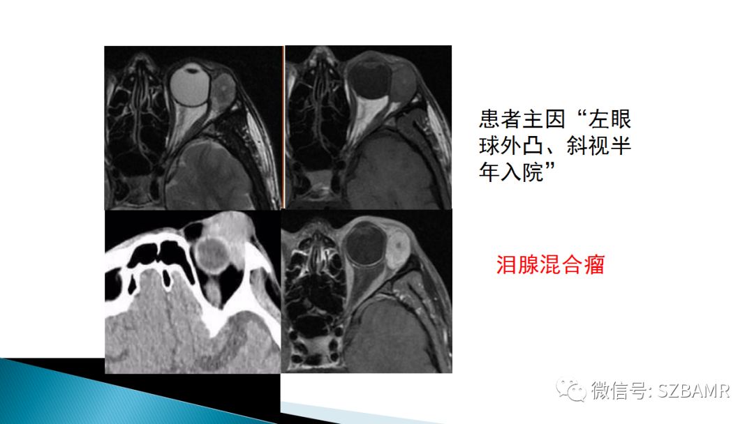 影像PPT - 【PPT】眼眶常见肿瘤的影像表现-9