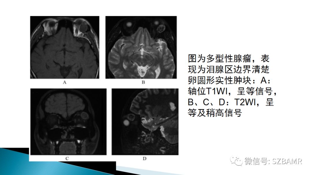 影像PPT - 【PPT】眼眶常见肿瘤的影像表现-10