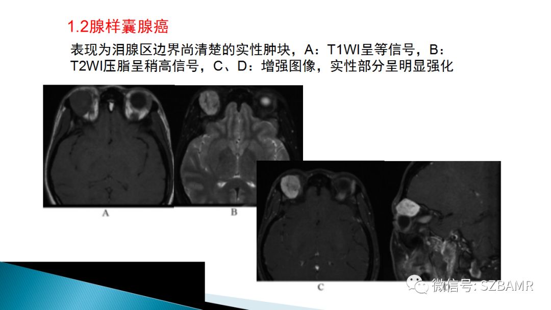 影像PPT - 【PPT】眼眶常见肿瘤的影像表现-11