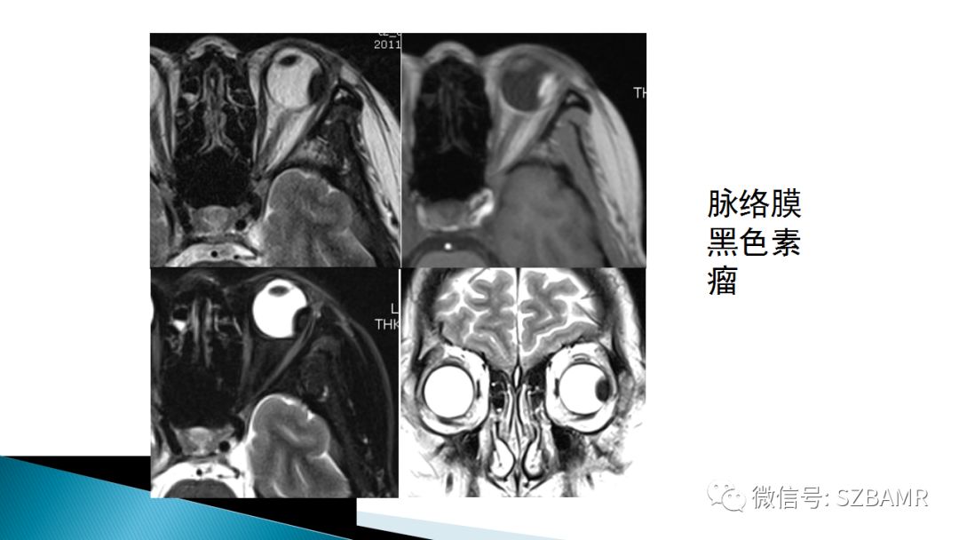 影像PPT - 【PPT】眼眶常见肿瘤的影像表现-14