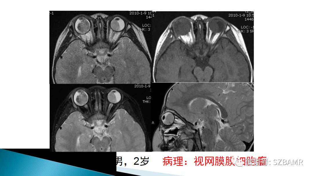 影像PPT - 【PPT】眼眶常见肿瘤的影像表现-17