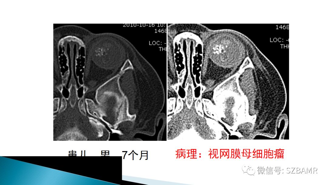 影像PPT - 【PPT】眼眶常见肿瘤的影像表现-16