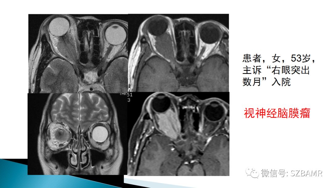 影像PPT - 【PPT】眼眶常见肿瘤的影像表现-20