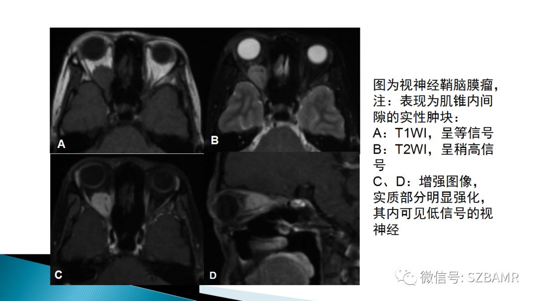 影像PPT - 【PPT】眼眶常见肿瘤的影像表现-21