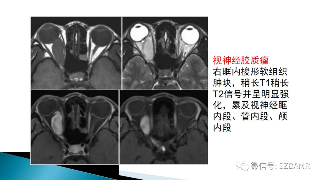 影像PPT - 【PPT】眼眶常见肿瘤的影像表现-23
