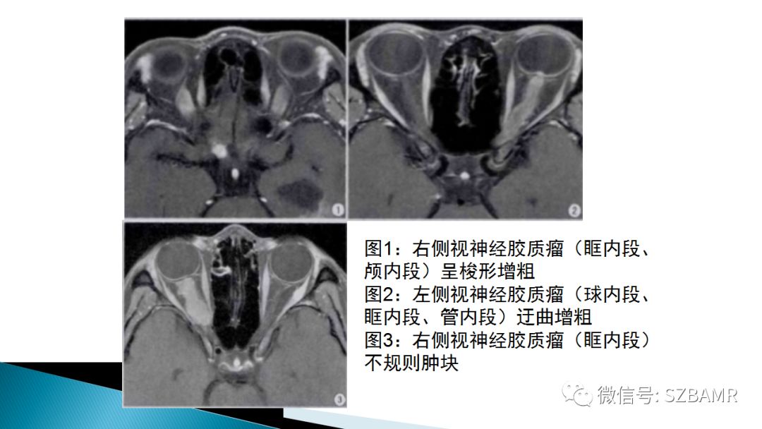 影像PPT - 【PPT】眼眶常见肿瘤的影像表现-25