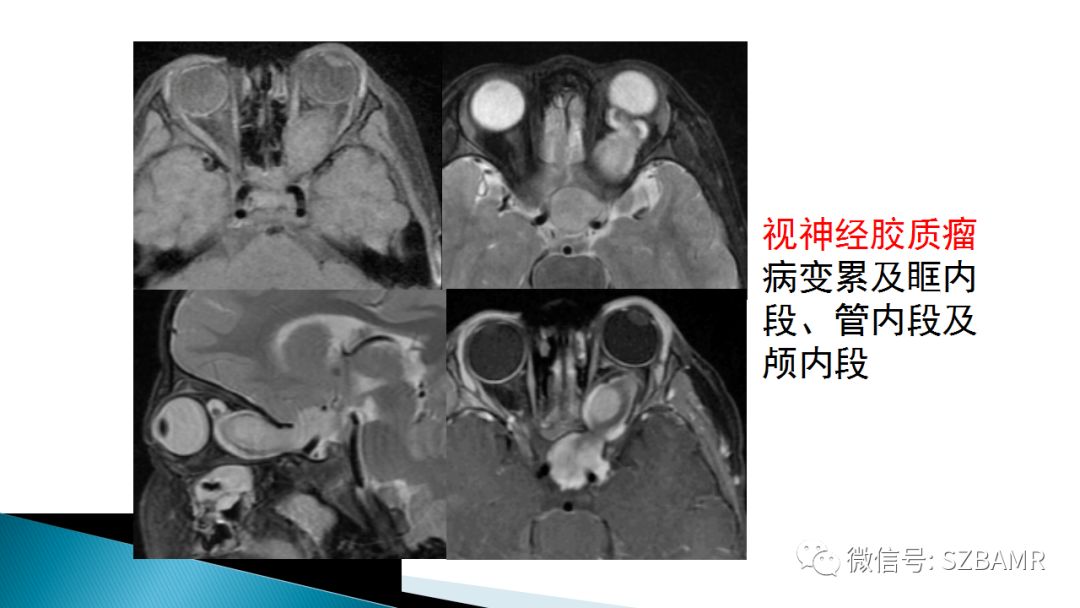 影像PPT - 【PPT】眼眶常见肿瘤的影像表现-24