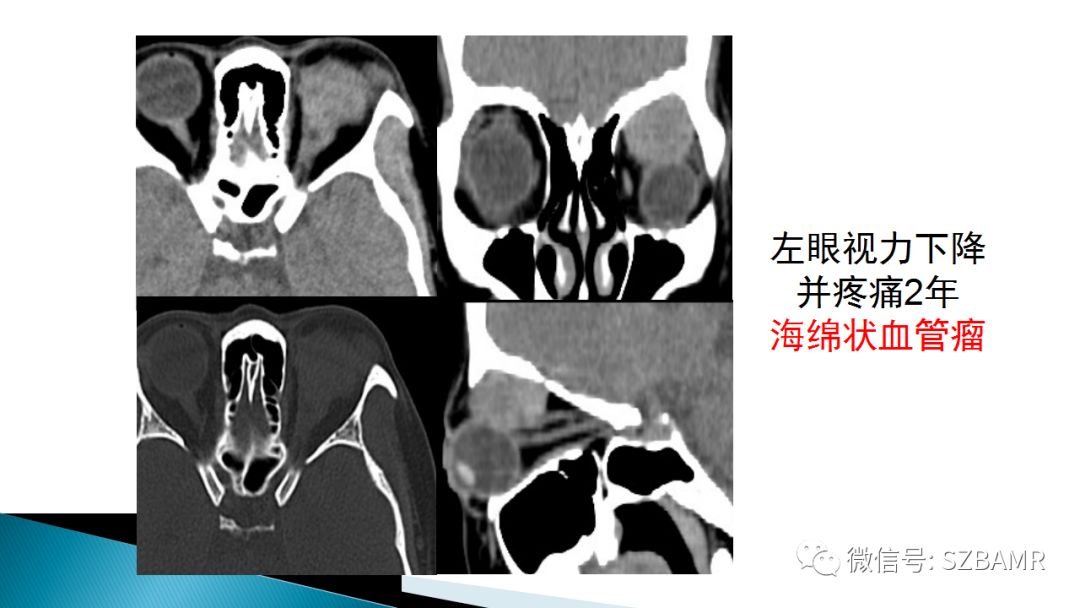 影像PPT - 【PPT】眼眶常见肿瘤的影像表现-30