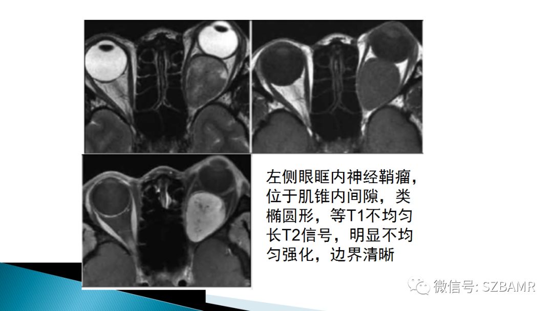 影像PPT - 【PPT】眼眶常见肿瘤的影像表现-32