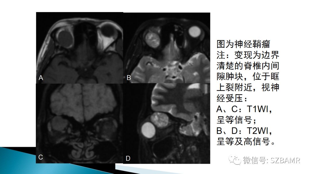 影像PPT - 【PPT】眼眶常见肿瘤的影像表现-33