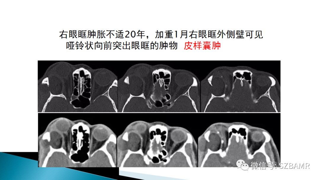 影像PPT - 【PPT】眼眶常见肿瘤的影像表现-36