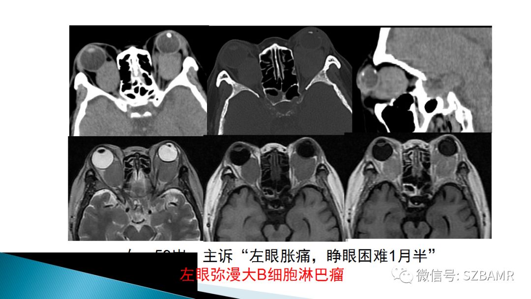 影像PPT - 【PPT】眼眶常见肿瘤的影像表现-39