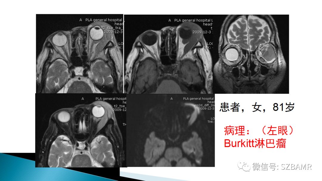 影像PPT - 【PPT】眼眶常见肿瘤的影像表现-40