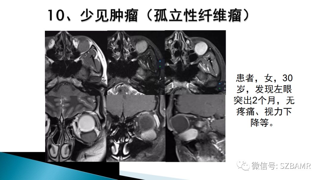 影像PPT - 【PPT】眼眶常见肿瘤的影像表现-42