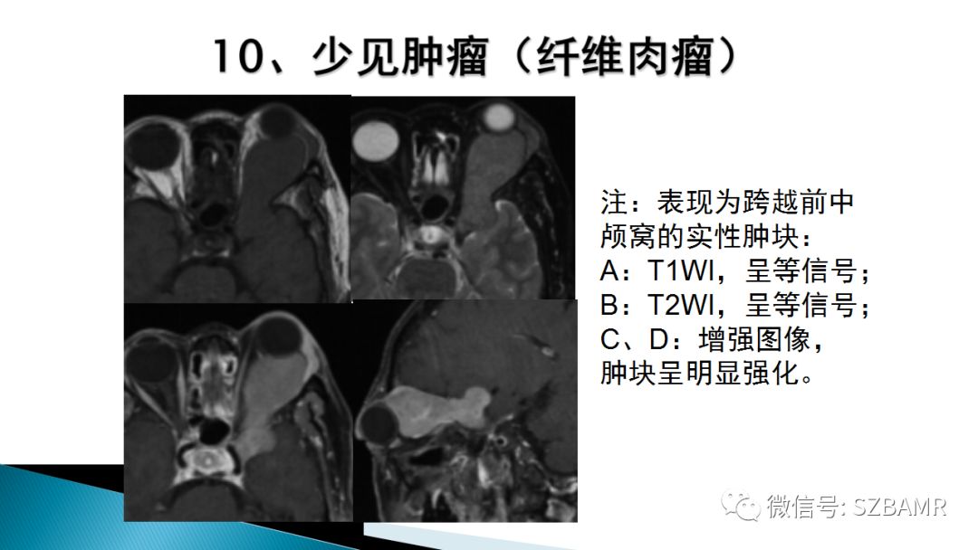 影像PPT - 【PPT】眼眶常见肿瘤的影像表现-43