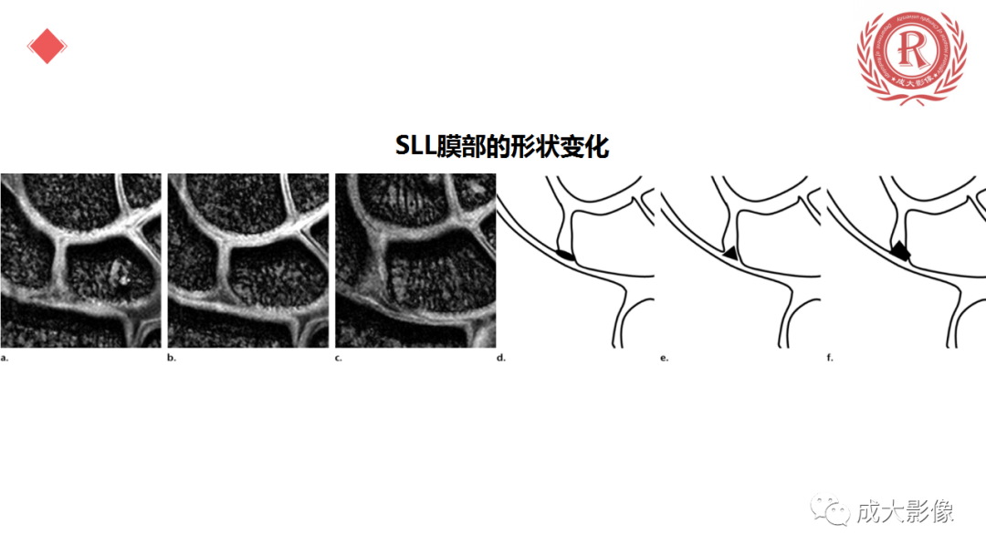 影像PPT - 【PPT】腕关节MRI解剖与临床-28