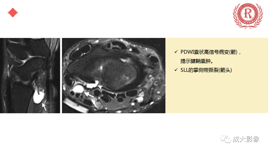 影像PPT - 【PPT】腕关节MRI解剖与临床-30