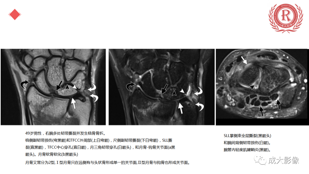 影像PPT - 【PPT】腕关节MRI解剖与临床-31