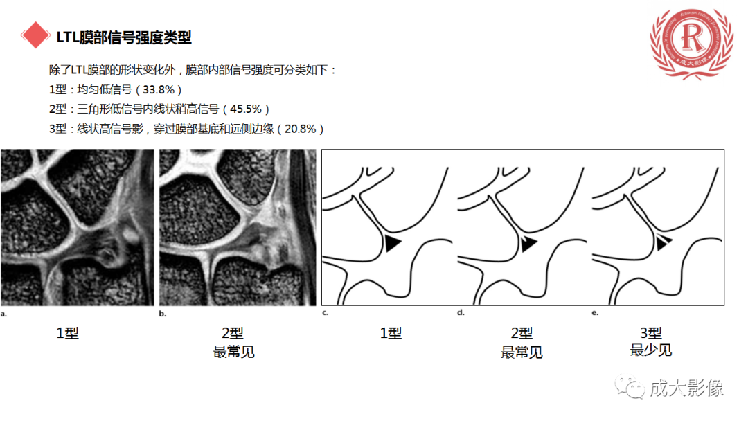 影像PPT - 【PPT】腕关节MRI解剖与临床-35