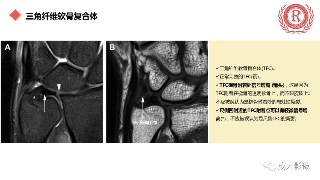 影像PPT - 【PPT】腕关节MRI解剖与临床-46