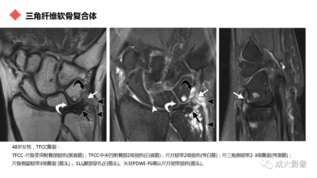 影像PPT - 【PPT】腕关节MRI解剖与临床-47