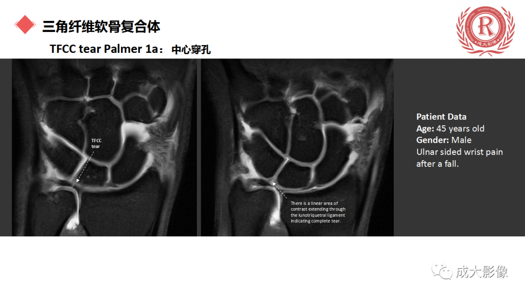 影像PPT - 【PPT】腕关节MRI解剖与临床-50