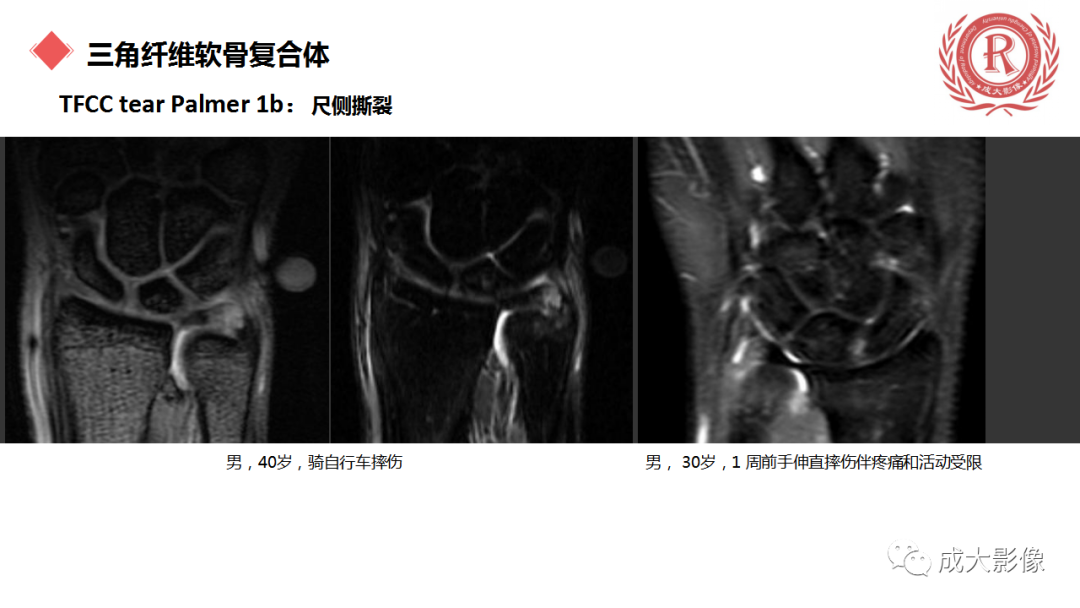 影像PPT - 【PPT】腕关节MRI解剖与临床-51