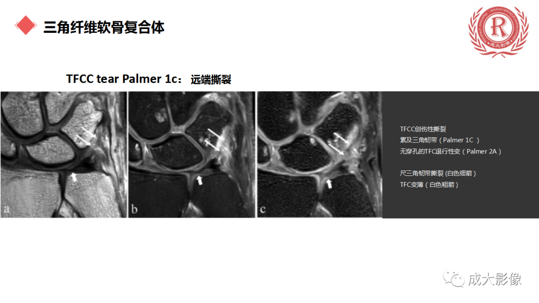 影像PPT - 【PPT】腕关节MRI解剖与临床-53