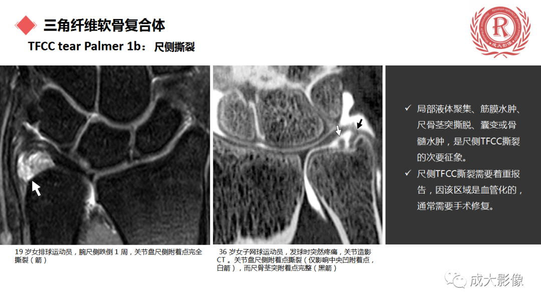 影像PPT - 【PPT】腕关节MRI解剖与临床-52