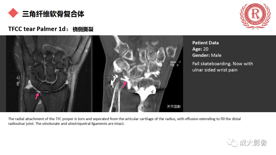 影像PPT - 【PPT】腕关节MRI解剖与临床-54