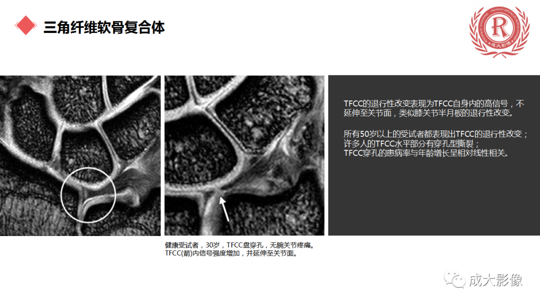 影像PPT - 【PPT】腕关节MRI解剖与临床-56