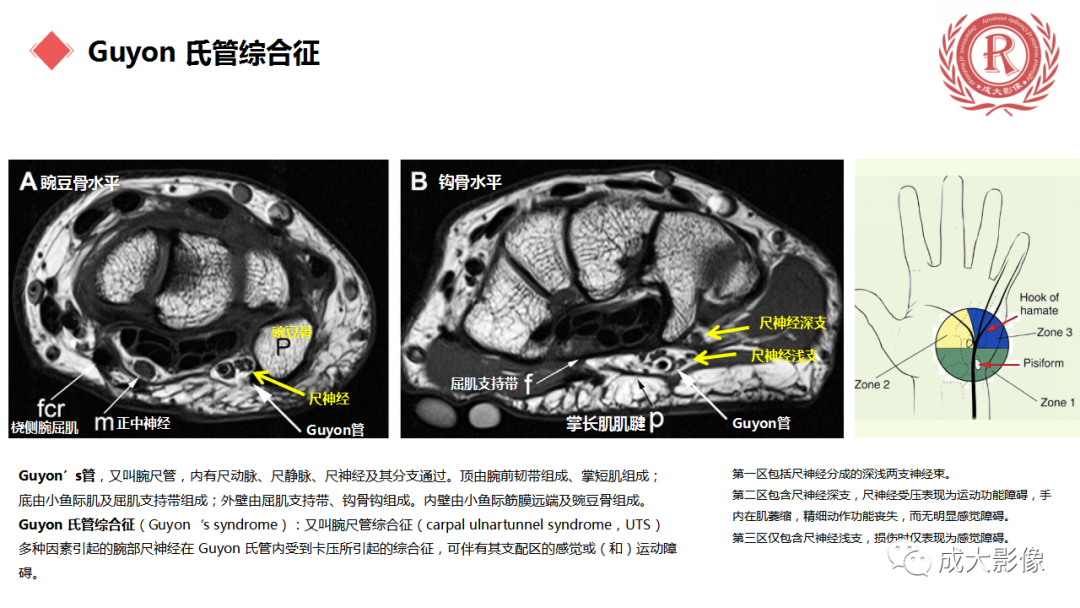 影像PPT - 【PPT】腕关节MRI解剖与临床-62