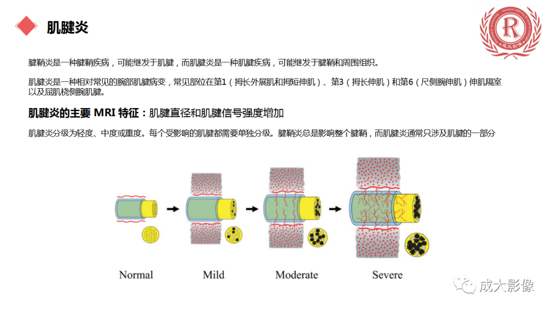 影像PPT - 【PPT】腕关节MRI解剖与临床-68