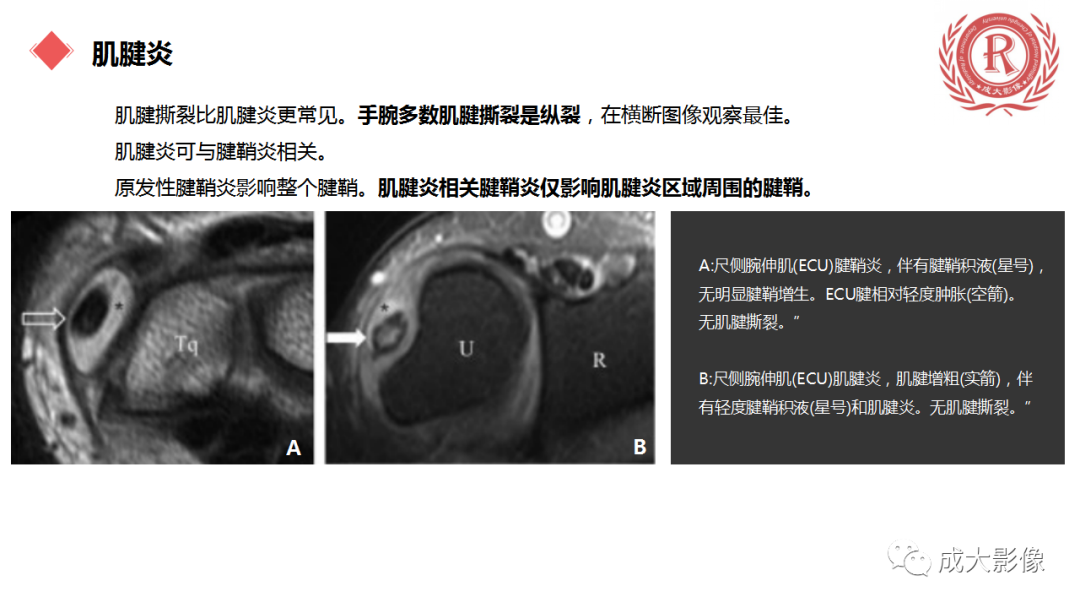 影像PPT - 【PPT】腕关节MRI解剖与临床-69