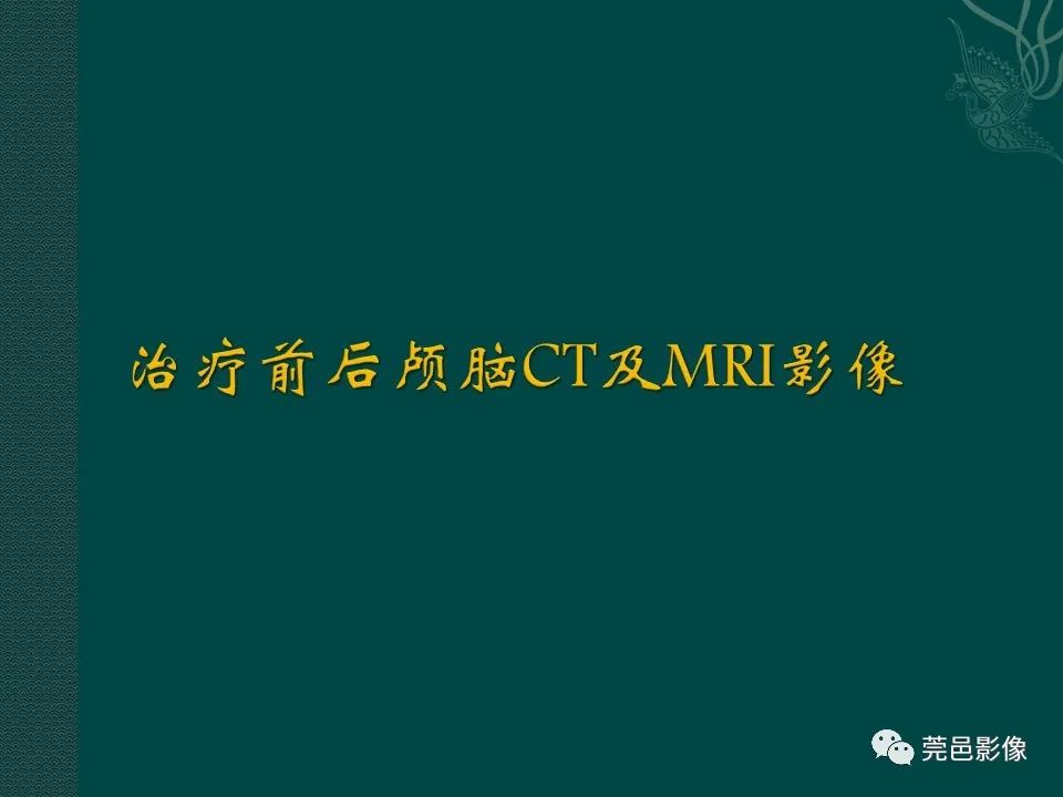 影像PPT - 【PPT】CAR-T治疗难治复发急性B淋巴细胞白血病相关性脑病（CRES）的影像学表现初步分析（1例）-7