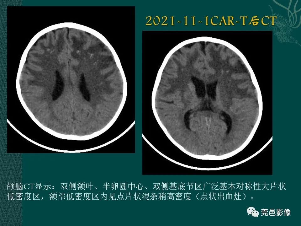 影像PPT - 【PPT】CAR-T治疗难治复发急性B淋巴细胞白血病相关性脑病（CRES）的影像学表现初步分析（1例）-9